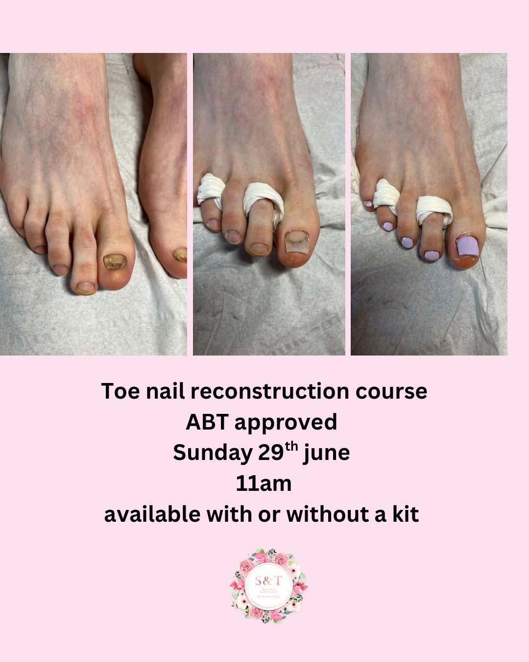 Toe nail reconstruction course approved by ABT